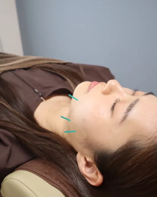 プレミアム美容鍼　60分